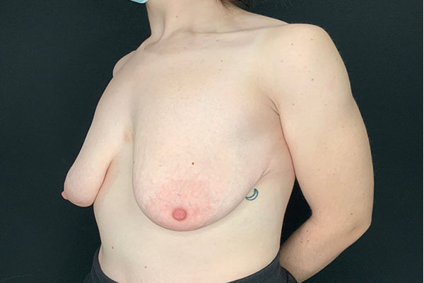 before breast lift left angle view female patient case 1858