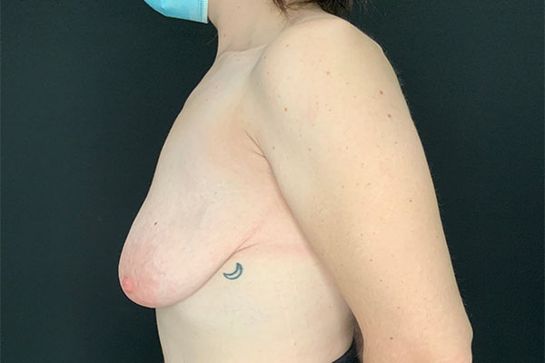 before breast lift left side view female patient case 1858