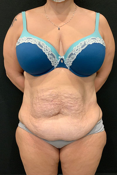 before tummy tuck front view female patient case 1801