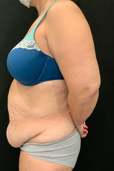 before tummy tuck left side view female patient case 1801