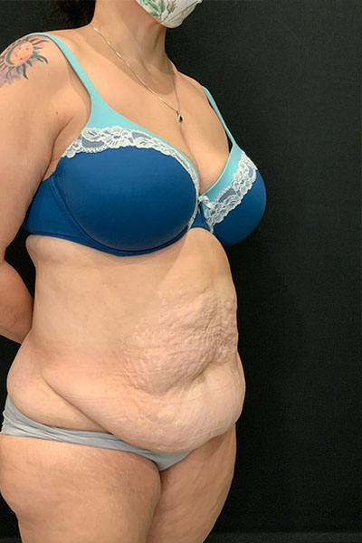before tummy tuck right angle view female patient case 1801