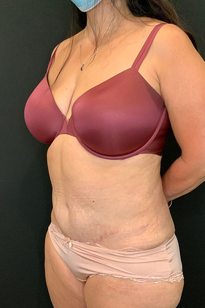after tummy tuck left angle view female patient case 1801
