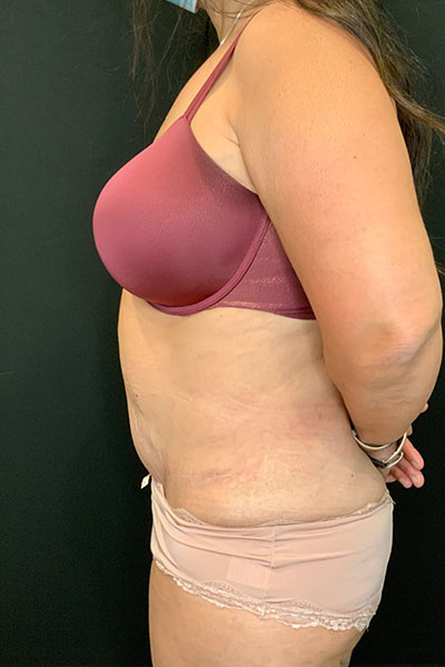 after tummy tuck left side view female patient case 1801