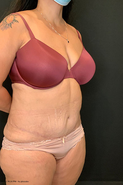 after tummy tuck right angle view female patient case 1801