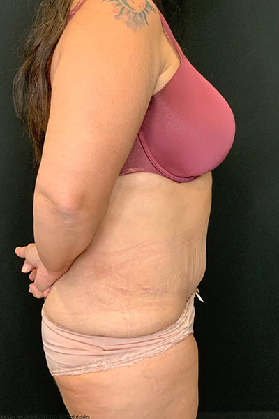 after tummy tuck right side view female patient case 1801
